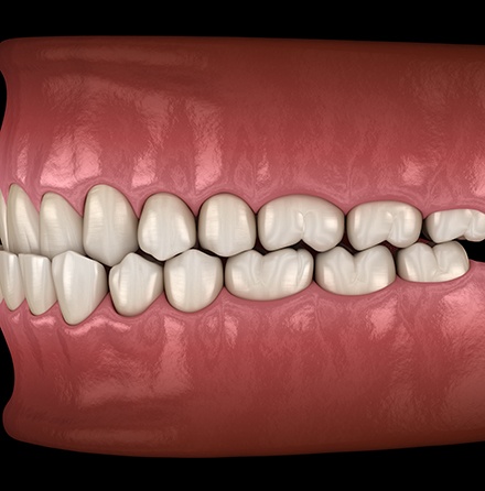 Illustration of an underbite