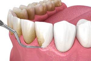 Illustration of plaque being removed from teeth