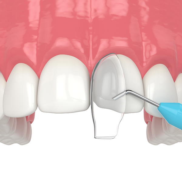 Illustration of dental bonding material being applied to a chipped tooth