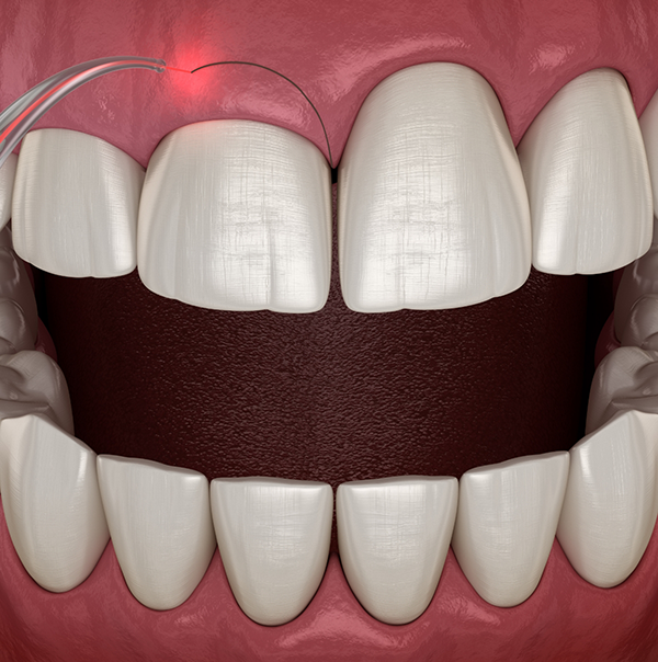 Illustration of a dental laser correcting a gummy smile