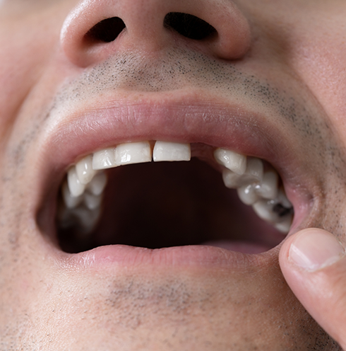 Close up of a mouth with one missing tooth