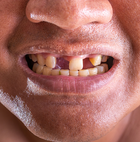 Close up of a mouth with multiple missing teeth