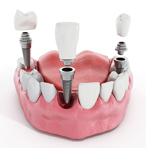 Illustration of three dental implants with abutments and dental crowns