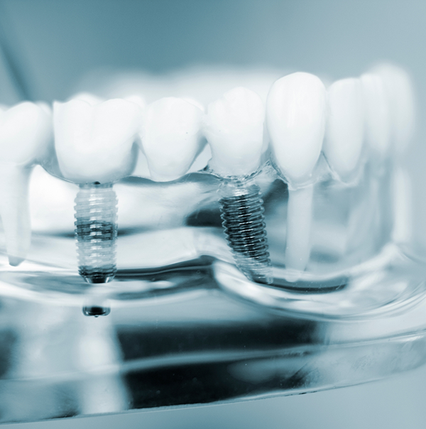 Model of the mouth with two dental implants