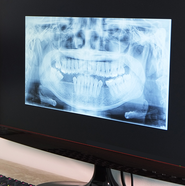 Computer screen showing a digital x ray of teeth