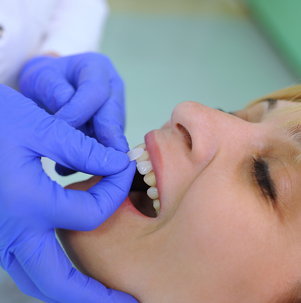 Dentist placing a veneer over a tooth