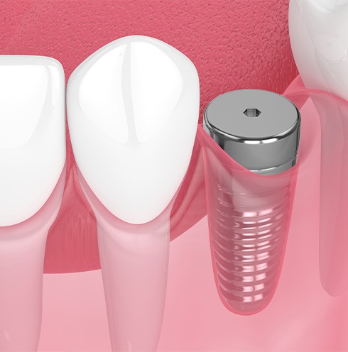 Digital illustration of dental implant