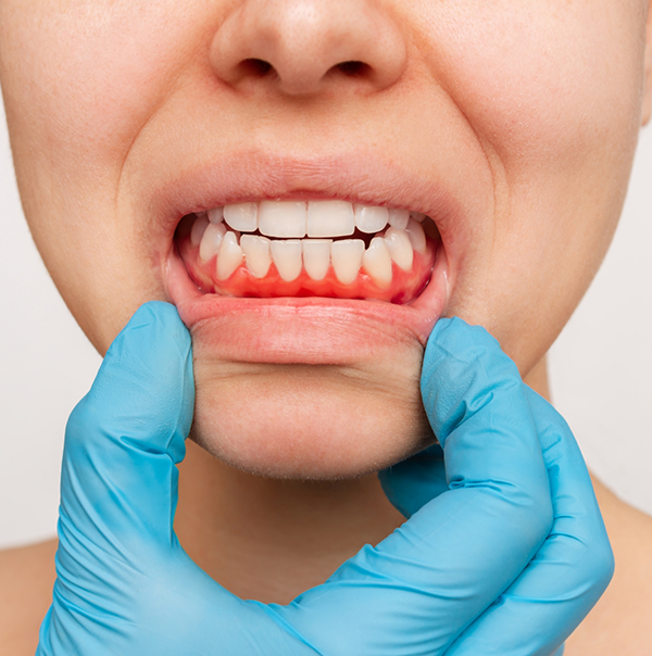 Person pulling down their lower lip to expose red gums