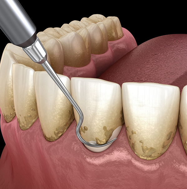 Illustrated dental scaler clearing plaque buildup from gumline