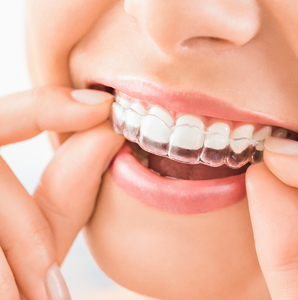 Close up of a person placing an Invisalign aligner over their upper teeth