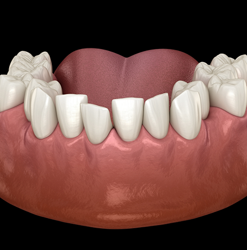 Illustrated row of crowded lower teeth