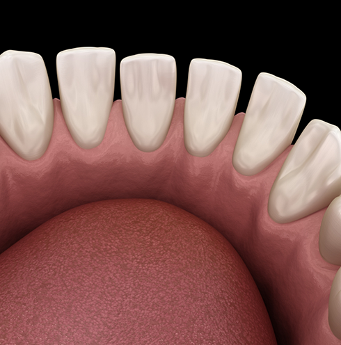 Illustrated row of gapped lower teeth