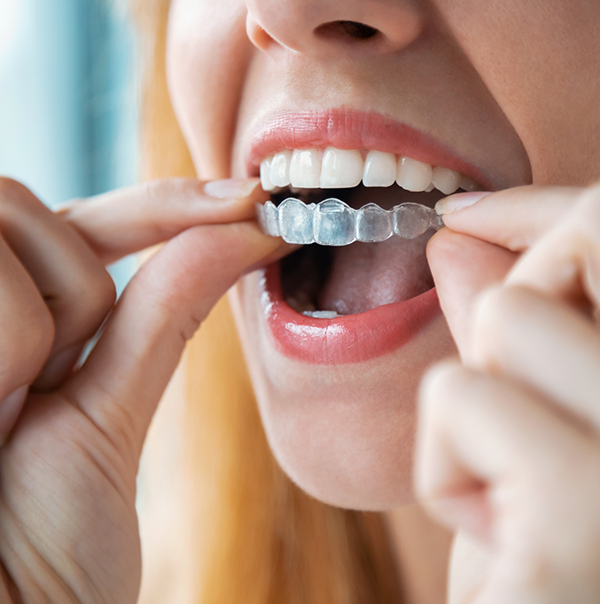 Close up of blonde woman placing Invisalign over her teeth