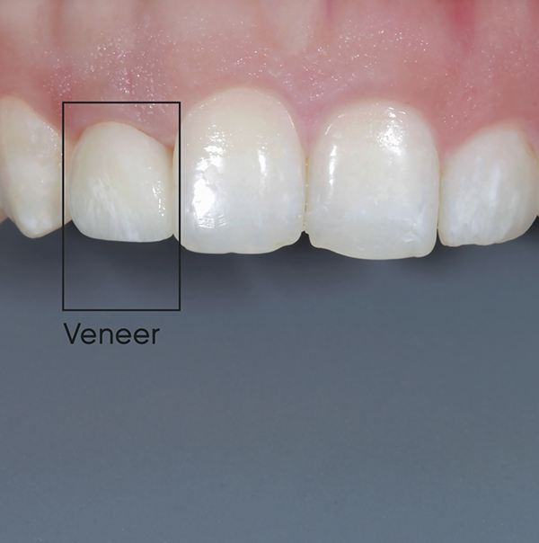 Close up of a row of teeth with a seamless looking veneer over one tooth