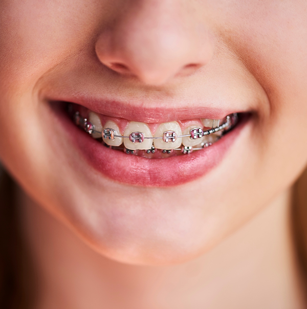 Close up of a person smiling with traditional metal braces