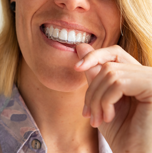 Woman placing an Invisalign aligner over her teeth