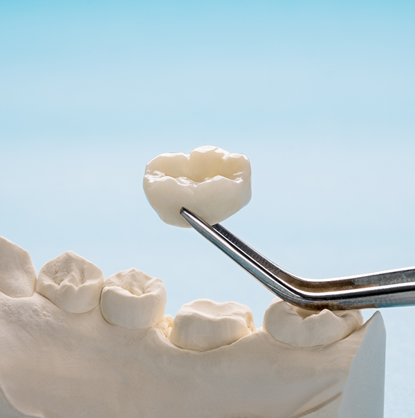 Tweezers holding a dental crown above a model of the mouth