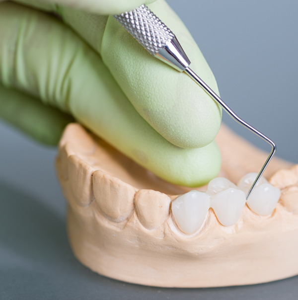 Dentist placing a dental bridge in a model of the mouth