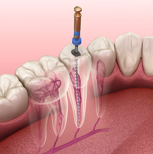 Illustrated dental instrument treating the inner layer of a tooth