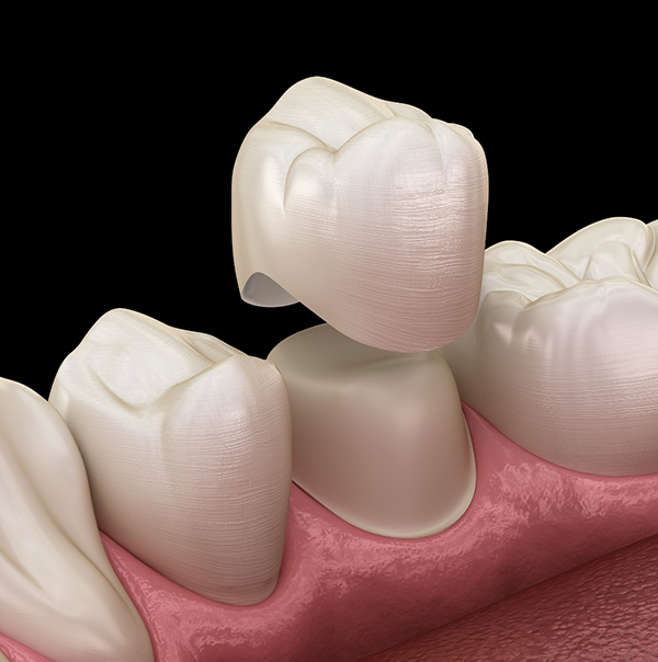 Illustrated dental crown being fitted over a tooth