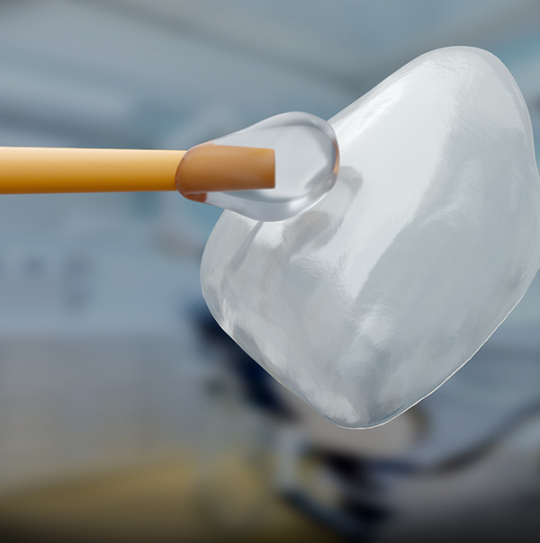 Close up of bonding material being applied to a veneer